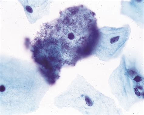 predominance of coccobacilli consistent with shift in flora|Bacterial Vaginosis and Cervical Intraepithelial Neoplasia: Is .